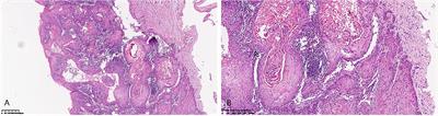 Pembrolizumab in FIGO IVB Verrucous Carcinoma of the Vulva: A Case Report